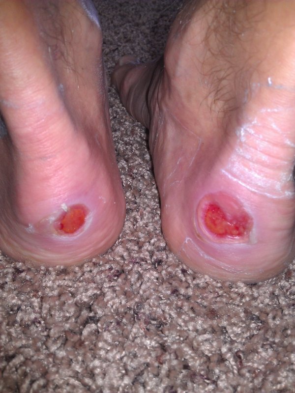 14962012coblisterfeet.jpg